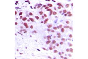 Immunohistochemical analysis of MEOX2 staining in human breast cancer formalin fixed paraffin embedded tissue section.