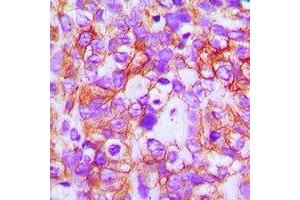 Immunohistochemical analysis of ABCB5 staining in human breast cancer formalin fixed paraffin embedded tissue section. (ABCB5 Antikörper)
