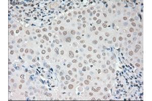 Immunohistochemical staining of paraffin-embedded liver tissue using anti-VEGFmouse monoclonal antibody. (VEGF Antikörper  (AA 27-233))