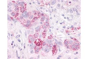 Anti-GPR3 antibody IHC of human Ovary, Carcinoma.