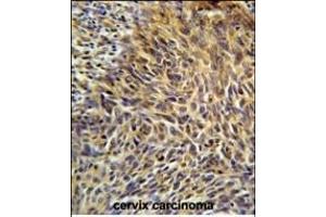 ANKRD32 Antibody (N-term) (ABIN651599 and ABIN2840316) immunohistochemistry analysis in formalin fixed and paraffin embedded human cervix carcinoma followed by peroxidase conjugation of the secondary antibody and DAB staining. (ANKRD32 Antikörper  (N-Term))