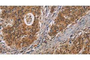 Immunohistochemistry of paraffin-embedded Human gastric cancer tissue using IL17D Polyclonal Antibody at dilution 1:50 (IL17D Antikörper)