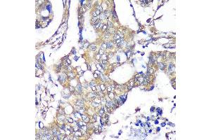 Immunohistochemistry of paraffin-embedded Human colon carcinoma using TXNDC9 Rabbit pAb  at dilution of 1:100 (40x lens). (TXNDC9 Antikörper  (AA 1-110))