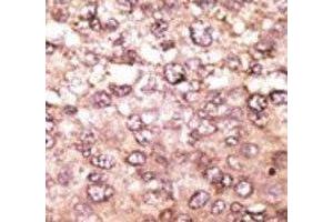 IHC analysis of FFPE human hepatocarcinoma tissue stained with the anti-ATG5 antibody (ATG5 Antikörper  (AA 209-238))