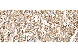Immunohistochemistry of paraffin-embedded Human lung cancer tissue using CHFR Polyclonal Antibody at dilution of 1:35(x200) (CHFR Antikörper)