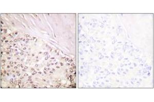 Immunohistochemistry analysis of paraffin-embedded human breast carcinoma tissue, using FANCD2 (Ab-222) Antibody.