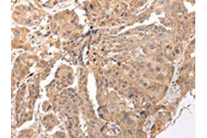The image on the left is immunohistochemistry of paraffin-embedded Human breast cancer tissue using ABIN7190290(CLDND2 Antibody) at dilution 1/45, on the right is treated with synthetic peptide. (CLDND2 Antikörper)