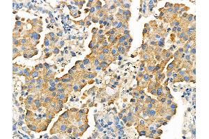 ABIN6257773 and ABIN6275331 at 1/100 staining Human lung cancer by IHC-P.