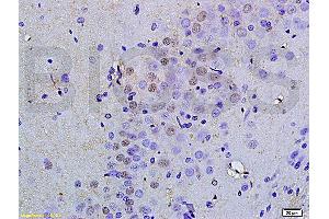 Formalin-fixed and paraffin embedded human colorectal cancer labeled with Anti OCT4B-190 Polyclonal Antibody, Unconjugated (ABIN704531) at 1:200 followed by conjugation to the secondary antibody and DAB staining (Oct-4BOCT4B-190NT (AA 201-300) Antikörper)