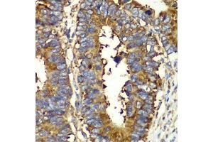 Immunohistochemistry of paraffin-embedded human colon carcinoma using QARS antibody. (QARS Antikörper  (AA 1-250))