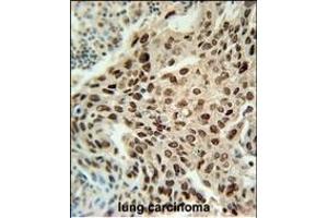 PRNIP Antibody (C-term) (ABIN651984 and ABIN2840482) immunohistochemistry analysis in formalin fixed and paraffin embedded human lung carcinoma followed by peroxidase conjugation of the secondary antibody and DAB staining. (ERI3 Antikörper  (C-Term))