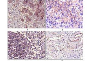 Immunohistochemical analysis of paraffin-embedded human lung cancer (A), cholangiocarcinorna (B), lymph node (C) and esophagus (D) tissues using NT5E mouse mAb with DAB staining. (CD73 Antikörper)