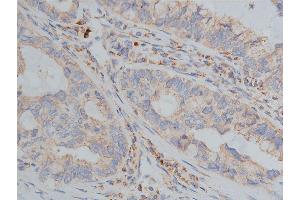 ABIN6268647 at 1/200 staining human lung cancer tissue sections by IHC-P.