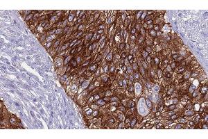 ABIN6268995 at 1/100 staining Human urothelial cancer tissue by IHC-P. (TGFBR2 Antikörper  (Internal Region))