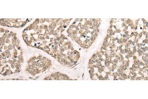 Immunohistochemistry of paraffin-embedded Human esophagus cancer tissue using CAPN15 Polyclonal Antibody at dilution of 1:50(x200) (Calpain 15/SOLH Antikörper)