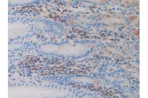 IHC-P analysis of Human Stomach Cancer Tissue, with DAB staining. (ADAM10 Antikörper  (AA 420-641))