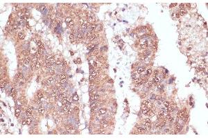 Immunohistochemistry of paraffin-embedded Human colon carcinoma using RAD50 Polyclonal Antibody at dilution of 1:100 (40x lens). (RAD50 Antikörper)