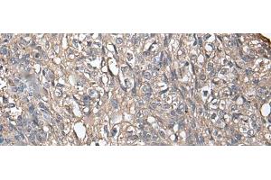 Immunohistochemistry of paraffin-embedded Human lung cancer tissue using NDUFB5 Polyclonal Antibody at dilution of 1:45(x200) (NDUFB5 Antikörper)