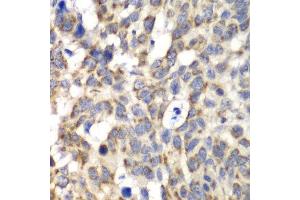 Immunohistochemistry of paraffin-embedded human esophageal cancer using PARN antibody at dilution of 1:100 (x40 lens). (PARN Antikörper)