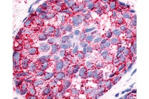 Anti-NPFFR1 / GPR147 antibody IHC of human Breast, Carcinoma.
