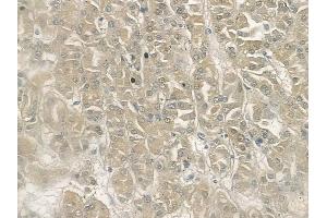 ABIN6262942 and ABIN6272945 at 1/100 staining human renal cell carcinoma by IHC-P. (LDHB Antikörper  (N-Term))
