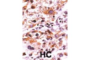 Formalin-fixed and paraffin-embedded human cancer tissue reacted with the primary antibody, which was peroxidase-conjugated to the secondary antibody, followed by AEC staining. (FGFR (pTyr766) Antikörper)