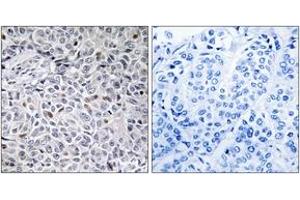Immunohistochemistry analysis of paraffin-embedded human breast carcinoma tissue, using ZAP-70 (Ab-315) Antibody. (ZAP70 Antikörper  (AA 281-330))