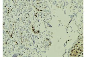ABIN6272922 at 1/100 staining Human breast cancer tissue by IHC-P. (FERMT2 Antikörper  (C-Term))