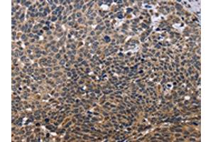 The image is immunohistochemistry of paraffin-embedded Human cervical cancer tissue using ABIN7129566(GADD45A Antibody) at dilution 1/30. (GADD45A Antikörper)