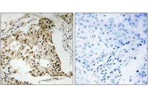 Immunohistochemistry analysis of paraffin-embedded human breast carcinoma, using Retinoic Acid Receptor alpha (Phospho-Ser77) Antibody. (Retinoic Acid Receptor alpha Antikörper  (pSer77))