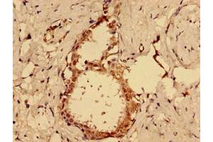 Immunohistochemistry of paraffin-embedded human ovarian cancer using ABIN7164435 at dilution of 1:100 (MKRN2 Antikörper  (AA 29-170))