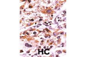 Formalin-fixed and paraffin-embedded human hepatocellular carcinoma tissue reacted with FGFR1 (phospho Y766) polyclonal antibody  which was peroxidase-conjugated to the secondary antibody followed by AEC staining. (FGFR1 Antikörper  (pTyr766))