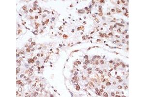 Immunohistochemistry of paraffin-embedded Human liver cancer using Phospho-Stat3(Y705) Polyclonal Antibody at dilution of 1:100 (40x lens). (STAT3 Antikörper  (pTyr705))