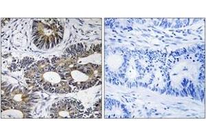 Immunohistochemistry analysis of paraffin-embedded human colon carcinoma tissue, using EIF1AY Antibody. (EIF1AY Antikörper  (AA 21-70))