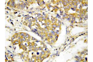 Anti-TLR4 antibody, IHC(P): Human Lung Cancer Tissue (TLR4 Antikörper  (N-Term))