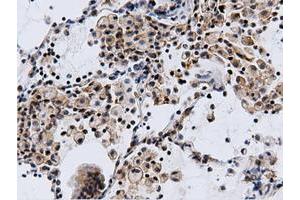 Immunohistochemical staining of paraffin-embedded Adenocarcinoma of Human breast tissue using anti-CBWD1 mouse monoclonal antibody. (CBWD1 Antikörper)