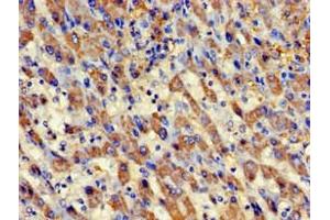 Immunohistochemistry of paraffin-embedded human liver cancer using ABIN7145083 at dilution of 1:100 (Aurora Kinase C Antikörper  (AA 12-143))