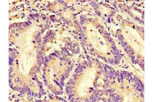 Immunohistochemistry of paraffin-embedded human colon cancer using ABIN7167611 at dilution of 1:100 (RGS4 Antikörper  (AA 1-205))