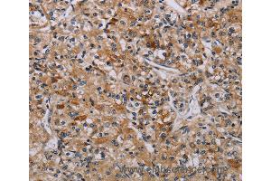 Immunohistochemistry of Human liver cancer using AATK Polyclonal Antibody at dilution of 1:45 (AATK Antikörper)