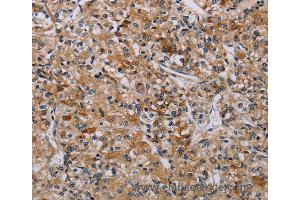Immunohistochemistry of Human liver cancer using AATK Polyclonal Antibody at dilution of 1:45