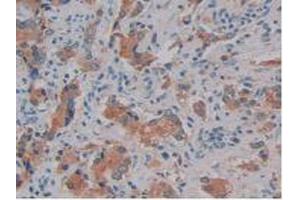 IHC-P analysis of Human Prostate Gland Cancer Tissue, with DAB staining. (Kallikrein 10 Antikörper  (AA 35-276))