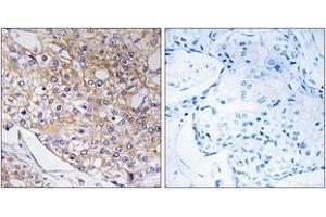 Immunohistochemistry analysis of paraffin-embedded human breast carcinoma tissue, using TRAPPC1 Antibody.