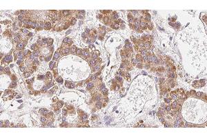 ABIN6279304 at 1/100 staining Human liver cancer tissue by IHC-P. (CLDN14 Antikörper  (C-Term))