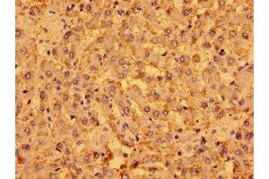 Immunohistochemistry of paraffin-embedded human liver cancer using ABIN7165807 at dilution of 1:100 (MENT (AA 24-197) Antikörper)