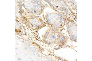Immunohistochemistry of paraffin-embedded human esophageal cancer using Integrin-β1/CD29 Rabbit mAb (ABIN7267926) at dilution of 1:5000 (40x lens). (ITGB1 Antikörper)