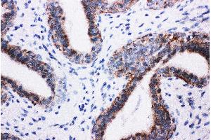 Anti-PI 3 Kinase p85 beta antibody, IHC(P) IHC(P): Human Mammary Cancer Tissue (PIK3R2 Antikörper  (Middle Region))