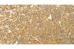 Immunohistochemistry of paraffin-embedded Human lymphoma using AARS2 Polyclonal Antibody at dilution of 1:40