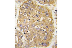 Formalin-fixed and paraffin-embedded human hepatocarcinoma tissue reacted with IGFBP3 Antibody (N-term) (ABIN391974 and ABIN2841768) , which was peroxidase-conjugated to the secondary antibody, followed by DAB staining. (IGFBP3 Antikörper  (N-Term))