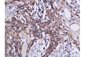 Formalin-fixed and paraffin embedded human colon carcinoma labeled with Anti-DAPK1 Polyclonal Antibody, Unconjugated  at 1:200 followed by conjugation to the secondary antibody and DAB staining (DAP Kinase 1 Antikörper  (AA 1331-1430))
