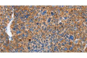Immunohistochemistry of paraffin-embedded Human liver cancer using AUP1 Polyclonal Antibody at dilution of 1:50 (Ancient Ubiquitous Protein 1 Antikörper)